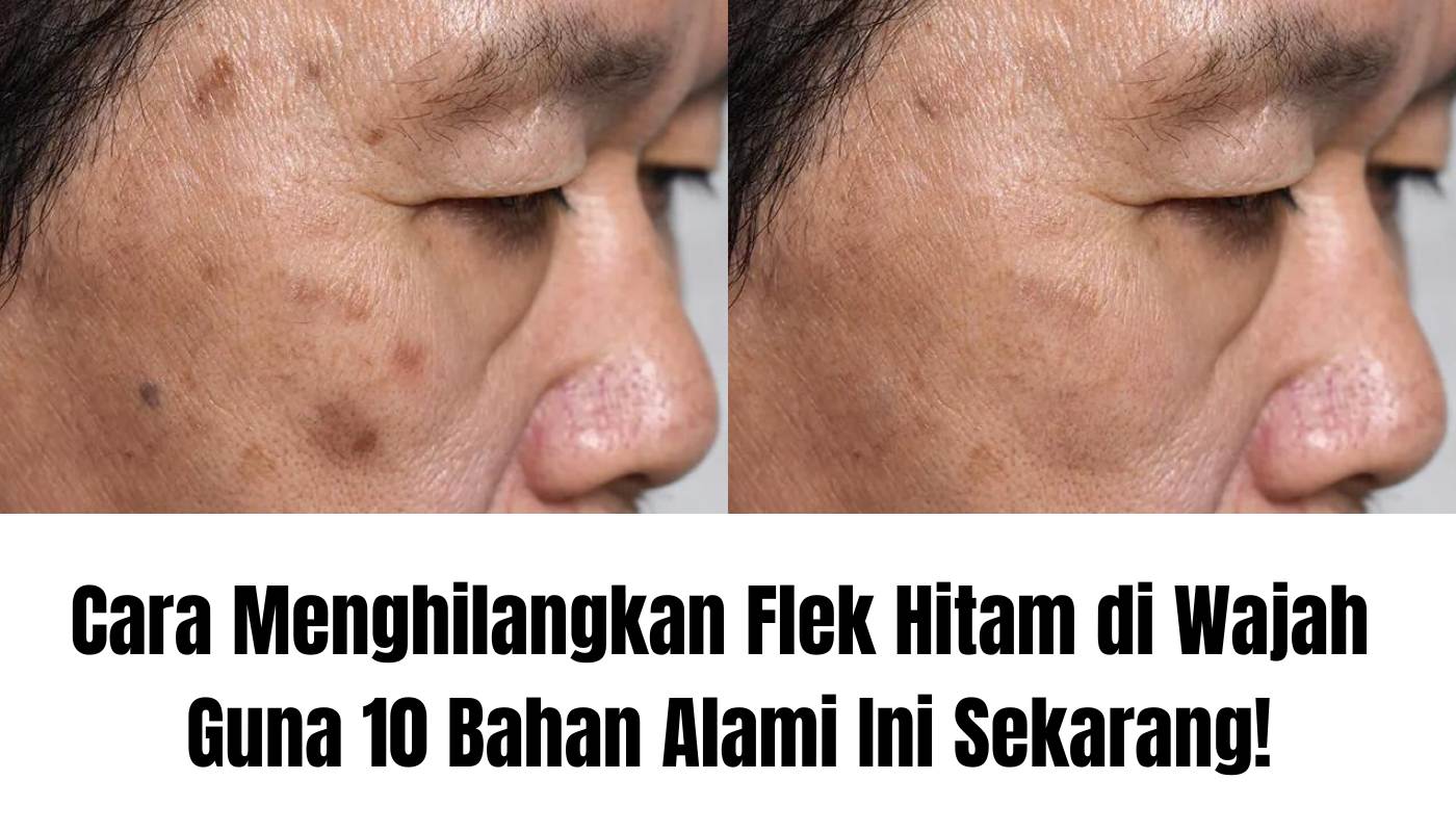 Cara Alami menghilangkan flek hitam di wajah